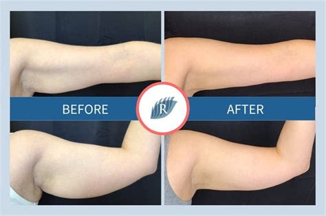 does coolsculpting work on arms.